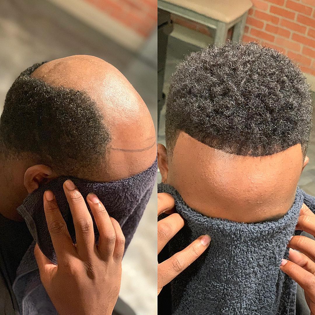 Hair replacement style inspiration for Alpharetta, Georgia